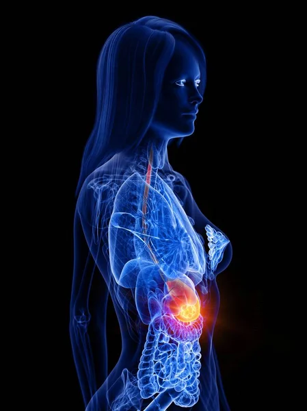 Câncer Estômago Corpo Feminino Ilustração Conceitual Computador — Fotografia de Stock