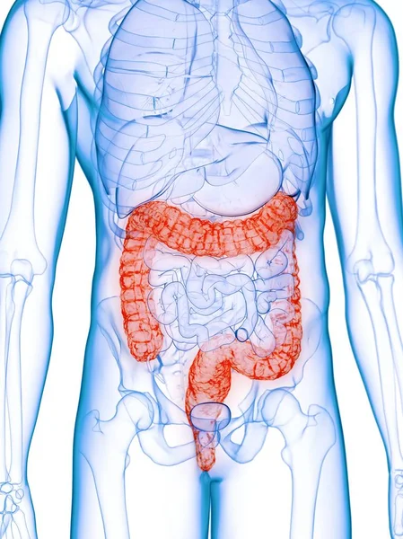 Male Body Diseased Colon Computer Illustration — Stock Photo, Image