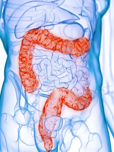 病気の結腸を持つ男性の体 コンピュータイラスト — ストック写真