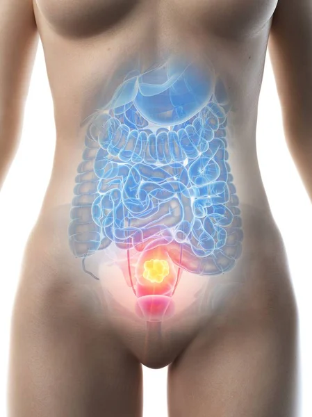 Cáncer Colon Cuerpo Femenino Ilustración Conceptual Por Computadora — Foto de Stock