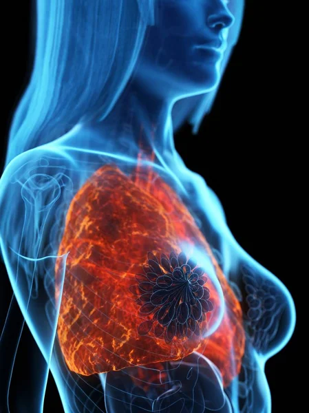 黒い背景の透明な女性の体の病気の肺 コンピュータイラスト — ストック写真