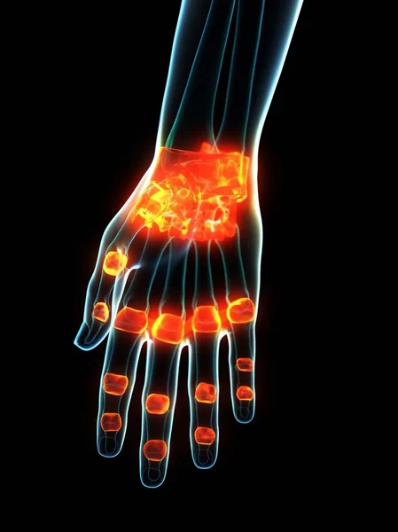 Inflamed Ligaments Human Hand Conceptual Computer Illustration — Stock Photo, Image