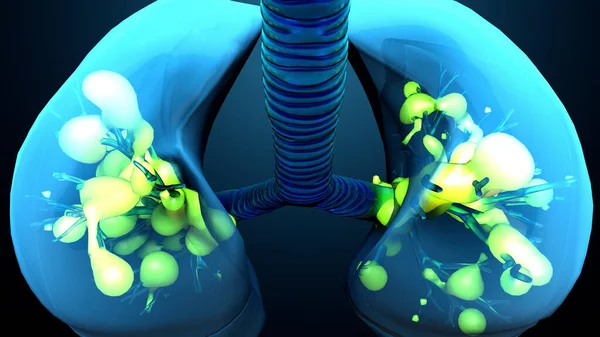 Pulmones Infectados Ilustración Por Computadora — Foto de Stock