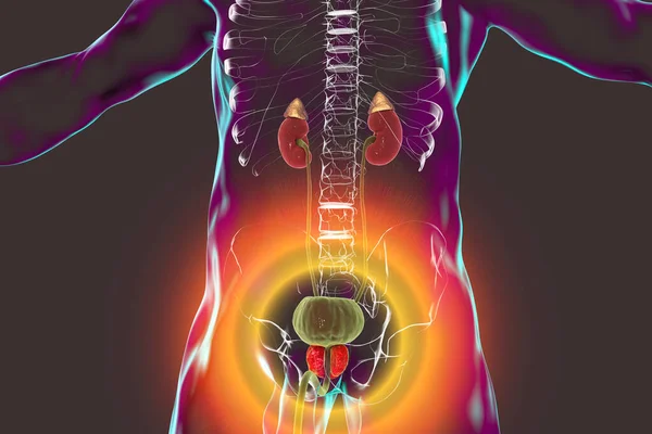 Ilustracja Łagodnego Rozrostu Stercza Hiperplazja Jest Nadmierny Wzrost Normalnych Komórek — Zdjęcie stockowe