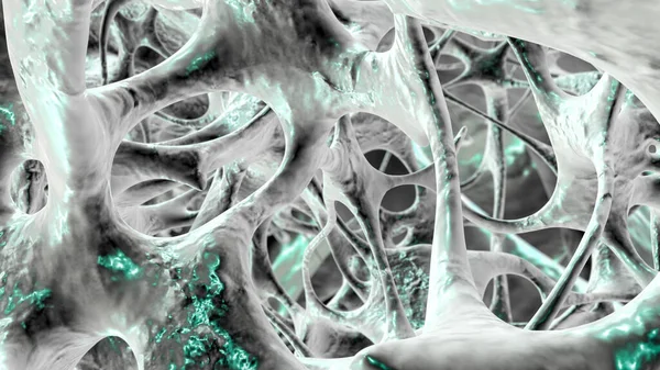 Ilustracja Struktury Kości Dotkniętych Osteoporozą Rozrzedzenie Matrycy Kostnej Jest Widoczne — Zdjęcie stockowe