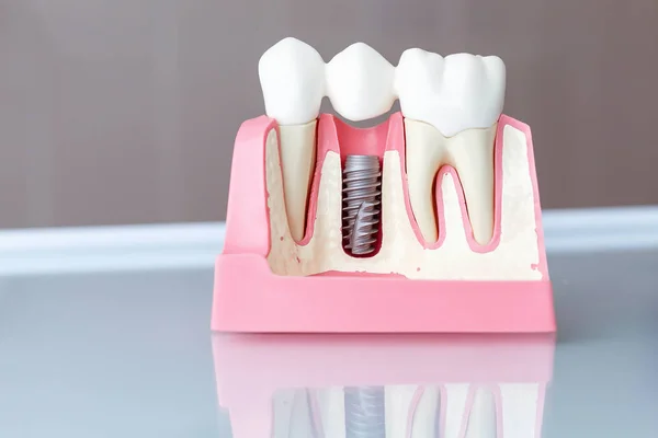 Close Dental Implant Model Selective Focus — Stock Photo, Image