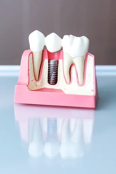 Close Dental Implant Model Selective Focus — Stock Photo, Image