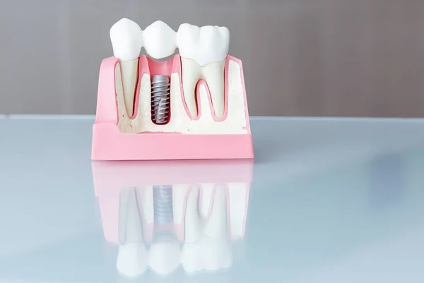 Close up of a Dental implant model. Selective focus.