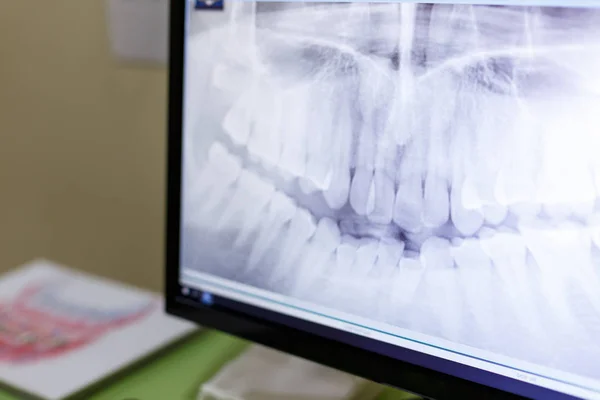 X-ray of head in the doctors office on a computer monitor