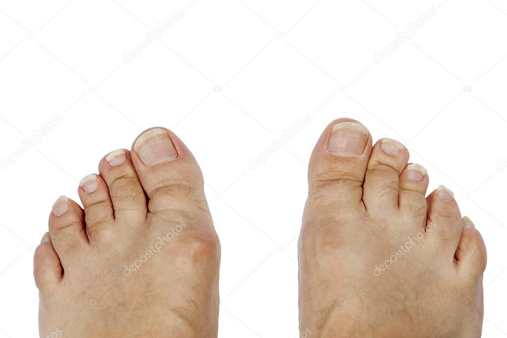 Long toenails. Isolate on a white background.