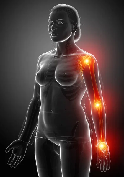 Illustration Female Arm Joint Pain — Stock Photo, Image