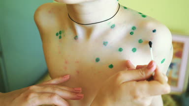 Su çiçeği olan küçük çocuk. Antiseptik çözüm döküntü için uygulama anne. Ev tedavisi.