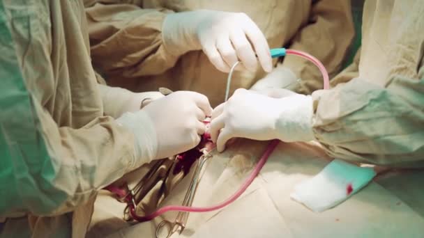 Műtőben Kórházi Műtőben Operáló Orvosi Csapat Sebészeti Műszerekkel Végzett Munka — Stock videók