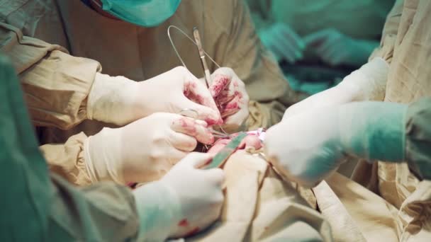 Los Cirujanos Realizan Cirugía Persona Del Paciente Los Guantes Quirófano — Vídeo de stock