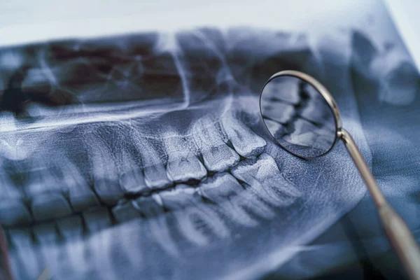 Instrumentos Dentales Radiografía Mandíbula Sobre Fondo Blanco Radiografía Panorámica Mandíbula — Foto de Stock