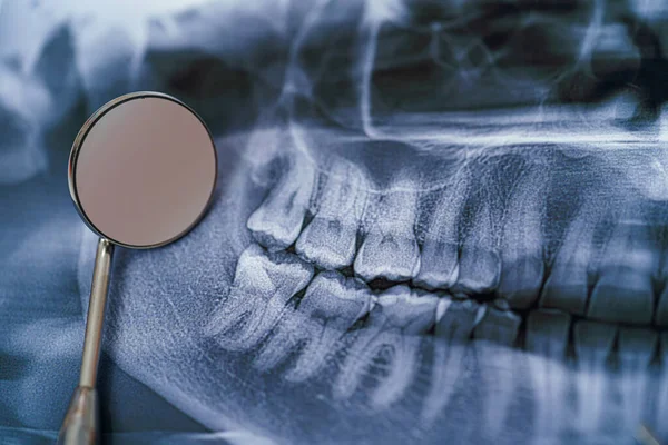 Panoramische Kaak Röntgenfoto Met Tandspiegel Tandheelkundige Behandeling Concept Sluitingsdatum — Stockfoto
