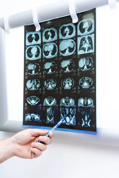 Radiografía Está Colgando Pizarra Iluminada Mano Médico Muestra Problemas Médicos —  Fotos de Stock