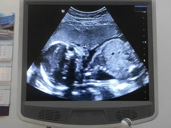 Screenshot Ultrasound Screen Blue Tones You Can See Body Skeleton — Stock Photo, Image