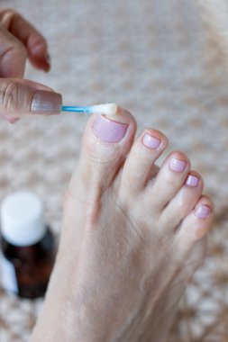 Woman Applying Anti fungus Medicine to infected Big Toe with a Cotton Swab clipart