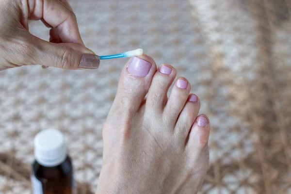 Woman Applying Fungus Medicine Infected Big Toe Cotton Swab — Stock Photo, Image