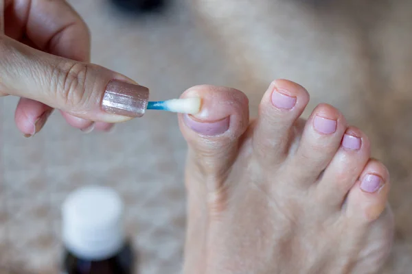 Woman Applying Anti fungus Medicine to infected Big Toe with a Cotton Swab