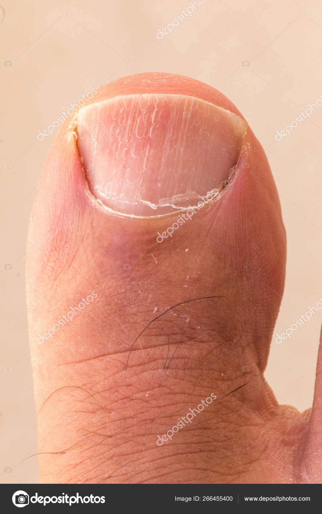 Big Toe Ingrown Toenail Scaly Dry Skin Cracking Stock Photo by ©marcoscasiano 266455400 Big Toe Ingrown Toenail Scaly Dry Skin Cracking Stock Photo by ©marcoscasiano 266455400