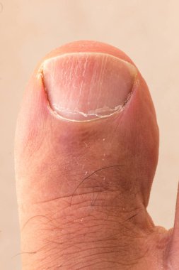 Batık Ayak Tırnak, Pullu, Kuru Cilt ve Çatlama ile Big Toe