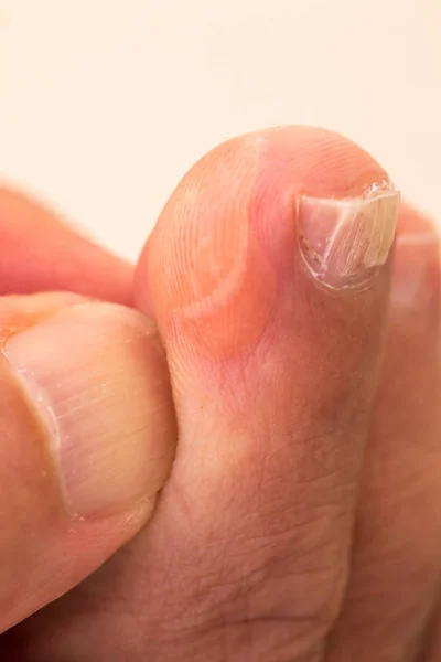 Пальцы Ног Большим Волдырем Сбоку Сухая Кожа Трещины — стоковое фото