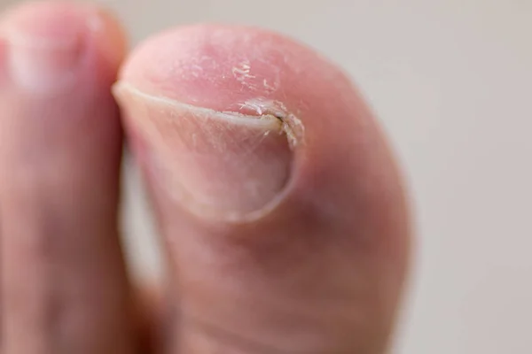 Batık Ayak Tırnak, Pullu, Kuru Cilt ve Çatlama ile Big Toe