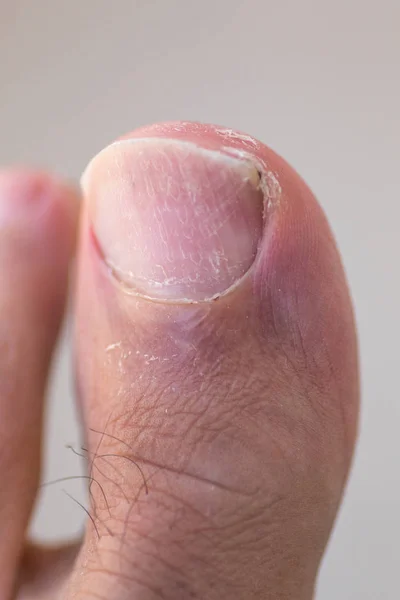 Big Toe Ingrown Toenail Scaly Dry Skin Cracking — Stock Photo, Image