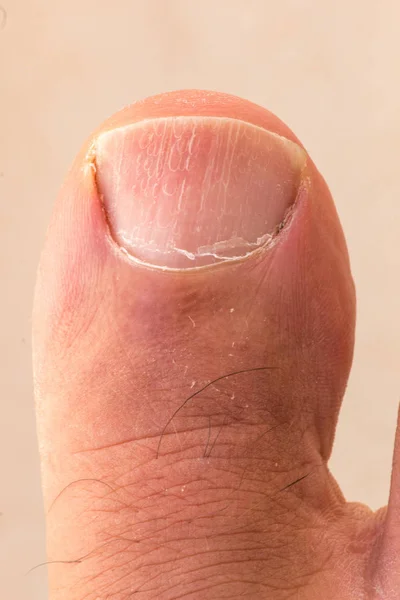 Μεγάλο Δάχτυλο Νύχι Του Ποδιού Φλούδα Ξηρό Δέρμα Και Ρωγμές — Φωτογραφία Αρχείου