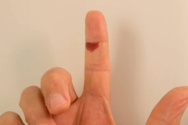 Blood Blister on a mans Index Finger