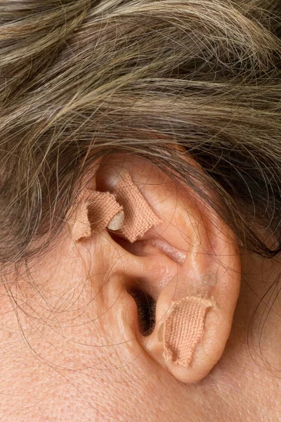 Woman who had ear acupuncture treatment done on her ear