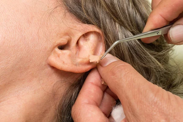 Woman who had ear acupuncture treatment done having the ear studs removed
