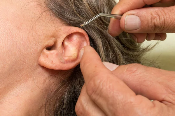 Mujer Que Sometió Tratamiento Acupuntura Oído Extirparon Los Pendientes — Foto de Stock