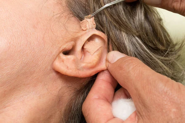 Mujer Que Sometió Tratamiento Acupuntura Oído Extirparon Los Pendientes — Foto de Stock