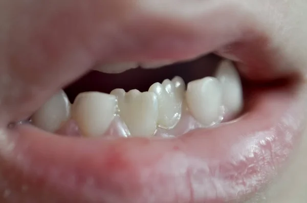 Permanent and milk teeth on a child. Gums are swollen. on some teeth there is some dental plaque. — Stock Photo, Image