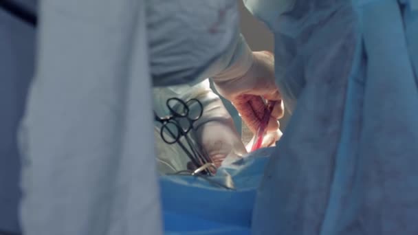 Diversos profissionais da equipe de cirurgiões em luvas utilizam instrumentos durante a realização de cirurgia invasiva no paciente em centro cirúrgico hospitalar — Vídeo de Stock
