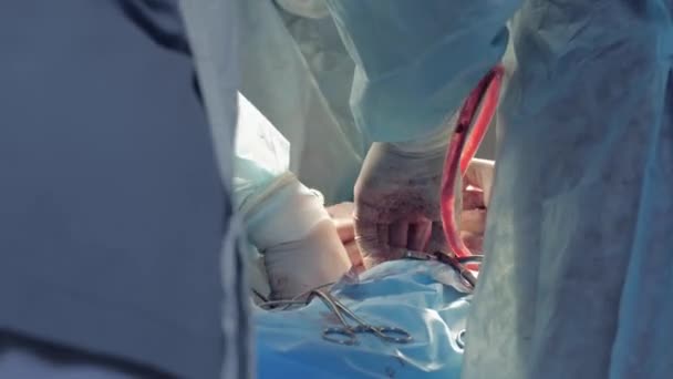 Manos operativas, equipo quirúrgico en guantes y ropa protectora remover la sangre de la incisión utilizando un tubo de succión durante la operación en el hospital — Vídeos de Stock
