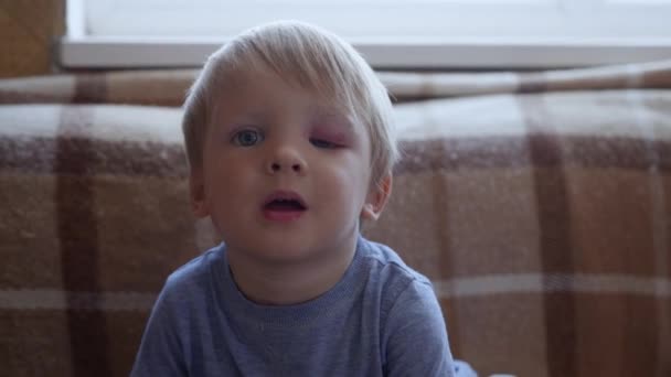 Kindheit, kleines süßes Kind mit Trauma im Gesicht und blauem Auge blickt in die Kamera auf dem Sofa, — Stockvideo