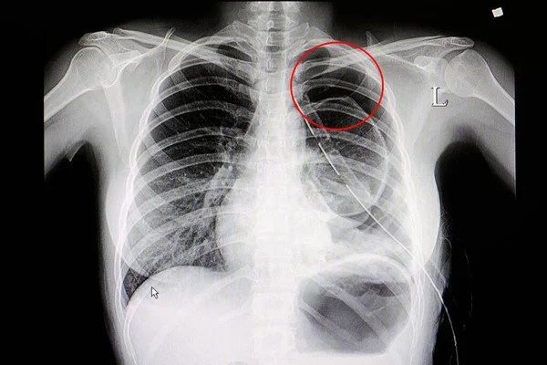 Radiografía Paciente Con Neumotórax Grande Con Drenaje Torácico — Foto de Stock