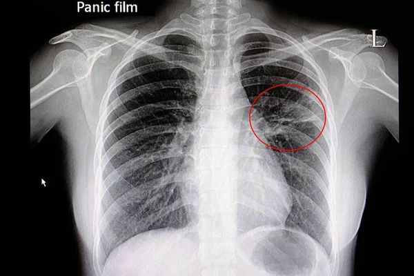 Radiografía Paciente Con Neumonía Pulmón Medio Izquierdo — Foto de Stock