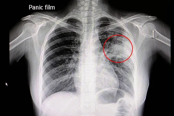 Radiografía Paciente Con Neumonía Pulmón Medio Izquierdo — Foto de Stock