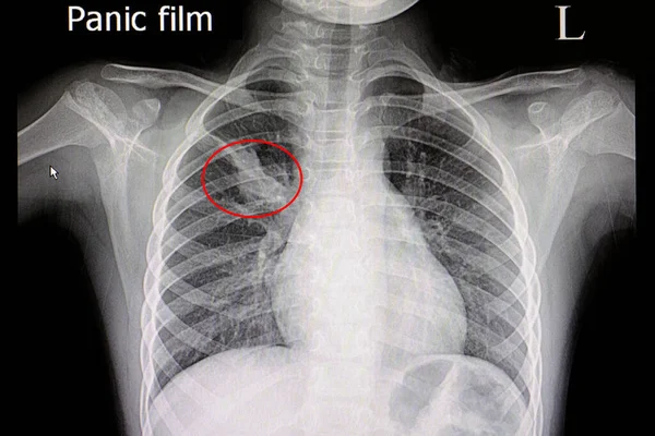Radiografía Paciente Con Neumonía Atelectasia Pulmón Superior Derecho — Foto de Stock