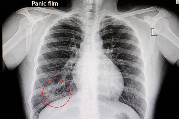 Radiografía Paciente Con Neumonía Pulmón Inferior Derecho — Foto de Stock