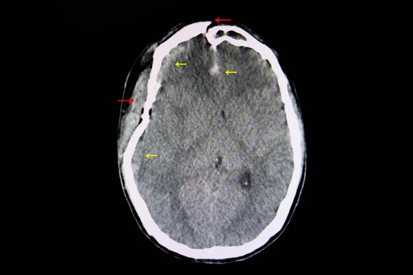 Tac Cerebral Paciente Con Traumatismo Craneoencefálico Que Muestra Fractura Depresiva — Foto de Stock