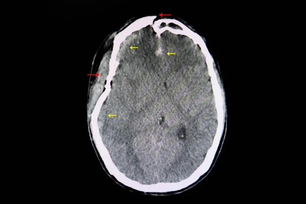 CT brain of a patient with head injury showing depression fracture of right temporal parietal and linear fracture of frontal bones with rigth subarachnoidal and frontal interhemispheric hemorrhage.