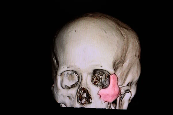 外傷性脳損傷患者の頭蓋骨の3Dレンダリング左頬骨の骨折を示す — ストック写真