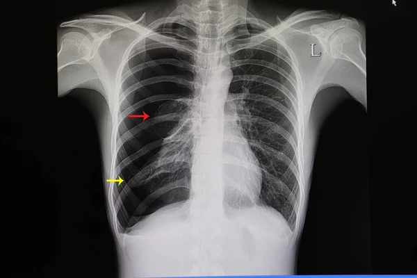 肺のほぼ完全な右側の崩壊 黄色の矢印 を伴う大規模な自発性肺炎の患者の胸部X線フィルム 肺の小葉も表示されます 赤い矢印 — ストック写真