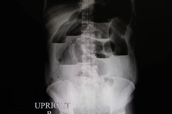 Una Radiografía Abdominal Paciente Con Obstrucción Intestinal Grande Completa Que —  Fotos de Stock